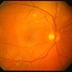 Choroidal Tumor, Breast Cancer